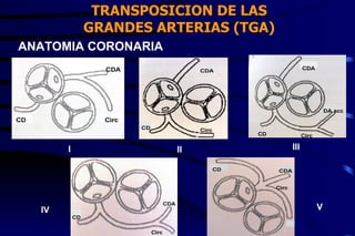 TRANSPOSICION DE LAS GRANDES ARTERIAS (TGA) ANATOMIA CORONARIA I II III IV V 