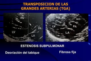 TRANSPOSICION DE LAS GRANDES ARTERIAS (TGA) ESTENOSIS SUBPULMONAR Desviación del tabique Fibrosa fija 