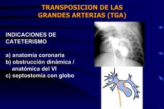 TRANSPOSICION DE LAS GRANDES ARTERIAS (TGA) INDICACIONES DE  CATETERISMO a) anatomía coronaria b) obstrucción dinámica /  anatómica del VI c) septostomía con globo 
