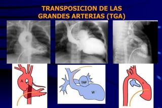 TRANSPOSICION DE LAS GRANDES ARTERIAS (TGA) 