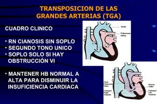 TRANSPOSICION DE LAS GRANDES ARTERIAS (TGA) CUADRO CLINICO RN CIANOSIS SIN SOPLO SEGUNDO TONO UNICO SOPLO SOLO SI HAY  OBSTRUCCIÓN VI MANTENER HB NORMAL A  ALTA PARA DISMINUIR LA  INSUFICIENCIA CARDIACA 