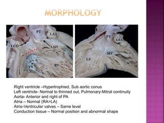 Right ventricle –Hypertrophied, Sub aortic conus
Left ventricle- Normal to thinned out, Pulmonary-Mitral continuity
Aorta- Anterior and right of PA
Atria – Normal (RA>LA)
Atrio-Ventricular valves – Same level
Conduction tissue – Normal position and abnormal shape
 