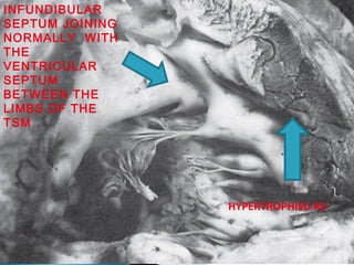 INFUNDIBULAR
SEPTUM JOINING
NORMALLY WITH
THE
VENTRICULAR
SEPTUM
BETWEEN THE
LIMBS OF THE
TSM
HYPERTROPHIED RV
 