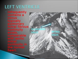 • Infrequently
contains a
conus
typically
pulmonary
mitral fibrous
continuity
exists,
comparable
with aortic
mitral
continuity in
the normal
heart.
MITRAL
VALVE
PULMONARY
VALVE
 
