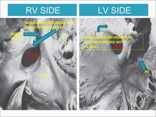 RV SIDE LV SIDE
MALALIGNED INFUNDIBULUM
DEVIATED TOWARDS LV
TSM
RV
VSD
PV
MALALIGNED INFUNDIBULAR
SEPTUM MERGING WITH
LV WALL VSD
AORTIC
VALVE
 