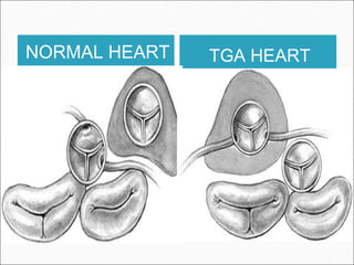 NORMAL HEART TGA HEART
 