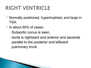  Normally positioned, hypertrophied, and large in
TGA.
 In about 90% of cases:
◦ Subaortic conus is seen,
◦ Aorta is rightward and anterior and ascends
parallel to the posterior and leftward
pulmonary trunk.
 