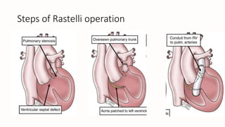 Transposition of great arteries with lvoto management | PPTX