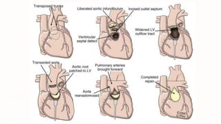 Transposition of great arteries with lvoto management | PPTX
