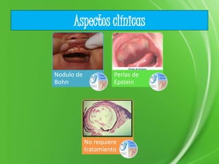 Aspectos clínicas
Nodulo de
Bohn
Perlas de
Epstein
No requiere
tratamiento
 
