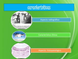 características
Aspecto radiográfico
Característica clínica
Aspecto histopatológico
 