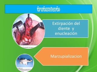 tratamiento
Extirpación del
diente y
enucleación
Marzupializacion
 