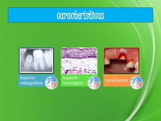 características
Aspecto
radiográfico
Aspecto
histológico
tratamiento
 