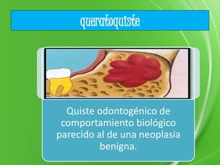 queratoquiste
Quiste odontogénico de
comportamiento biológico
parecido al de una neoplasia
benigna.
 