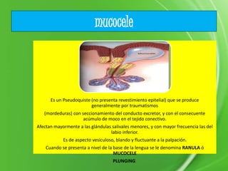 mucocele
Es un Pseudoquiste (no presenta revestimiento epitelial) que se produce
generalmente por traumatismos
(mordeduras) con seccionamiento del conducto excretor, y con el consecuente
acúmulo de moco en el tejido conectivo.
Afectan mayormente a las glándulas salivales menores, y con mayor frecuencia las del
labio inferior.
Es de aspecto vesiculoso, blando y fluctuante a la palpación.
Cuando se presenta a nivel de la base de la lengua se le denomina RANULA ó
MUCOCELE
PLUNGING.
 