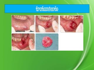 tratamiento
 