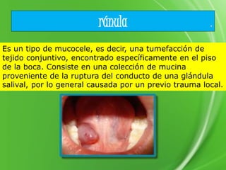ránula
Es un tipo de mucocele, es decir, una tumefacción de
tejido conjuntivo, encontrado específicamente en el piso
de la boca. Consiste en una colección de mucina
proveniente de la ruptura del conducto de una glándula
salival, por lo general causada por un previo trauma local.
 