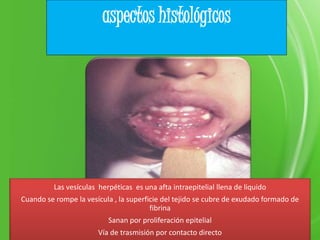 Se presenta
aspectos histológicos
Las vesículas herpéticas es una afta intraepitelial llena de liquido
Cuando se rompe la vesícula , la superficie del tejido se cubre de exudado formado de
fibrina
Sanan por proliferación epitelial
Vía de trasmisión por contacto directo
 