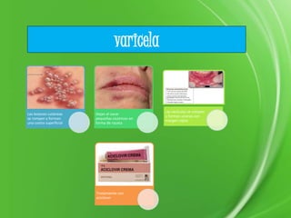 varicela
Las lesiones cutáneas
se rompen y forman
una costra superficial
Dejan al sanar
pequeñas cicatrices en
forma de roceta
Las vesículas se rompen
y forman ulceras con
margen rojizo
Tratamiento con
aciclover
 