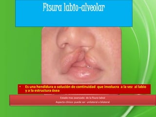 Estado mas avanzado de la fisura labial
Aspecto clínico: puede ser unilateral o bilateral
Fisura labio-alveolar
• Es una hendidura o solución de continuidad que involucra a la vez al labio
y a la estructura ósea
 