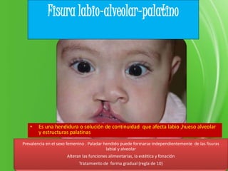 Prevalencia en el sexo femenino . Paladar hendido puede formarse independientemente de las fisuras
labial y alveolar
Alteran las funciones alimentarias, la estética y fonación
Tratamiento de forma gradual (regla de 10)
• Es una hendidura o solución de continuidad que afecta labio ,hueso alveolar
y estructuras palatinas
Fisura labio-alveolar-palatino
 
