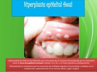 enfermedad de Heck es una afección poco frecuente de la mucosa oral producida por la asociación
entre el virus de papiloma humano ubtipos 13 y 32, y un factor genético predisponente.
Clínicamente se caracteriza por la ocurrencia de múltiples pápulas circunscriptas o nódulos en la
cavidad oral, especialmente en la mucosa labial, yugal y lingual
Hiperplasia epitelial focal
 