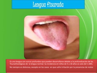 Es una lengua con surcos profundos que pueden desarrollarse debido a la profundización de las
fisurasfisiológicas de la lengua normal. Su incidencia en niños de 5 a 18 años es solo del 1.08%.
No siempre es dolorosa, excepto en los casos en que sufre irritación por la presencias de restos
Lengua fisurada
 