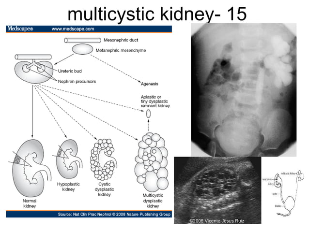 Kidney Rotation Congenital lesions and variants of renal system | PPT