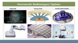 TREATMENT OF TGN WITH CYBERKNIFE FRAMELESS RADIOSURGERY SYSTEM | PPTX