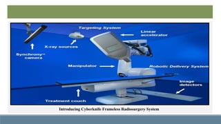 TREATMENT OF TGN WITH CYBERKNIFE FRAMELESS RADIOSURGERY SYSTEM | PPTX