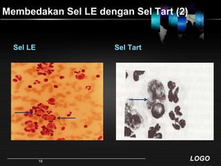 Membedakan Sel LE dengan Sel Tart (2)Sel LESel Tart18