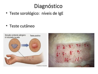 Diagnóstico
• Teste sorológico: níveis de IgE
• Teste cutâneo
 