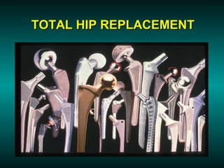 TOTAL HIP REPLACEMENT
 