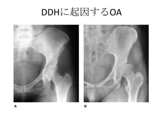 DDHに起因するOA
 
