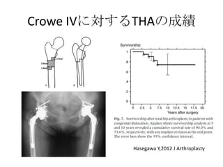 Crowe IVに対するTHAの成績




           Hasegawa Y,2012 J Arthroplasty
 