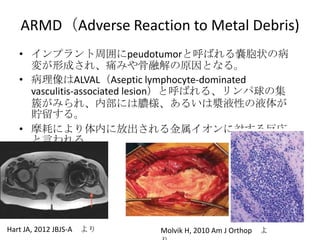 ARMD（Adverse Reaction to Metal Debris)
   • インプラント周囲にpeudotumorと呼ばれる嚢胞状の病
     変が形成され、痛みや骨融解の原因となる。
   • 病理像はALVAL（Aseptic lymphocyte-dominated
     vasculitis-associated lesion）と呼ばれる、リンパ球の集
     簇がみられ、内部には膿様、あるいは漿液性の液体が
     貯留する。
   • 摩耗により体内に放出される金属イオンに対する反応
     と言われる。




Hart JA, 2012 JBJS-A より   Molvik H, 2010 Am J Orthop   よ
 