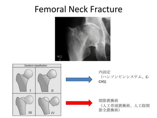 Femoral Neck Fracture




               内固定
               （ハンソンピンシステム、C-
               CHS)



               関節置換術
               （人工骨頭置換術、人工股関
               節全置換術）
 