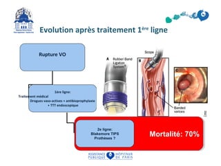 Evolution après traitement 1ère ligne 
Rupture VO 
1ère ligne: 
Traitement médical 
Drogues vaso-actives + antibioprophylaxie 
+ TTT endoscopique 
MMoorrttaalliittéé:: 7700%% 2e ligne: 
Blakemore TIPS 
Prothèses ? 
 