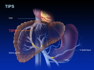 TIPS 
VSH 
Veine porte 
V Splénique 
VMS 
TIPS 
 