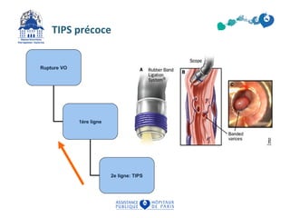 TIPS précoce 
Rupture VO 
1ère ligne 
2e ligne: TIPS 
 
