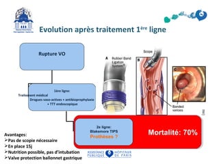 Evolution après traitement 1ère ligne 
Rupture VO 
1ère ligne: 
Traitement médical 
Drogues vaso-actives + antibioprophylaxie 
+ TTT endoscopique 
MMoorrttaalliittéé:: 7700%% 
2e ligne: 
Blakemore TIPS 
Avantages: Prothèses ? 
Pas de scopie nécessaire 
En place 15j 
Nutrition possible, pas d’intubation 
Valve protection ballonnet gastrique 
 