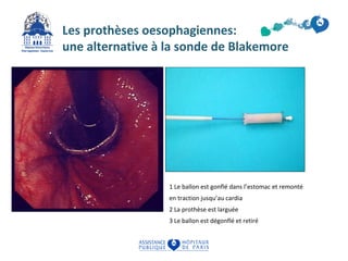 Les prothèses oesophagiennes: 
une alternative à la sonde de Blakemore 
1 Le ballon est gonflé dans l’estomac et remonté 
en traction jusqu’au cardia 
2 La prothèse est larguée 
3 Le ballon est dégonflé et retiré 
 
