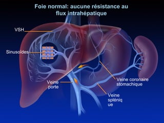 VSH 
Sinusoïdes 
Foie normal: aucune résistance au 
Veine 
porte 
Veine coronaire 
stomachique 
Veine 
spléniq 
ue 
flux intrahépatique 
 