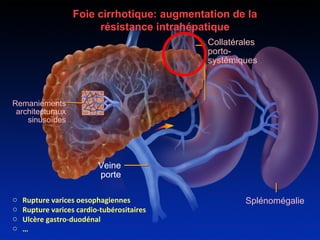 Foie cirrhotique: augmentation de la 
Collatérales 
porto-systémiques 
Remaniements 
architecturaux 
sinusoïdes 
Veine 
porte 
Splénomégalie 
résistance intrahépatique 
o Rupture varices oesophagiennes 
o Rupture varices cardio-tubérositaires 
o Ulcère gastro-duodénal 
o … 
 