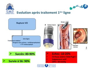 Evolution après traitement 1ère ligne 
Rupture VO 
1ère ligne: 
Traitement médical 
Drogues vaso-actives + antibioprophylaxie 
+ TTT endoscopique 
 Succès: 80-90% 
 Survie à S6: 90% 
 Echec: 10-20% 
 Cirrhose sévère Child-Pugh C 
 Saignement actif 
 GPH > 20 mmHg 
 