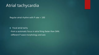 Atrial tachycardia
Regular atrial rhythm with P rate > 100
 Focal atrial tachy
-from a automatic focus in atria firing faster than SAN.
-different P wave morphology and axis
 
