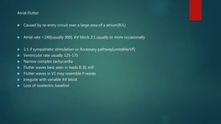 Atrial Flutter
 Caused by re-entry circuit over a large area of a atrium[R/L]
 Atrial rate >240[usually 300]. AV block 2:1 usually or more occasionally
 1:1 if sympathetic stimulation or Accessary pathway[unstable/VF]
 Ventricular rate usually 125-175
 Narrow complex tachycardia
 Flutter waves best seen in leads II, III, aVF
 Flutter waves in V1 may resemble P waves
 Irregular with variable AV block
 Loss of isoelectric baseline
 