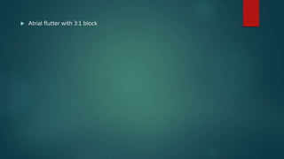  Atrial flutter with 3:1 block
 