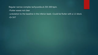 Regular narrow-complex tachycardia at 250-300 bpm.
-Flutter waves not clear
-undulation to the baseline in the inferior leads –Could be flutter with a 1:1 block.
-Or SVT
 
