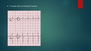  P waves seen as Pseudo R waves
 